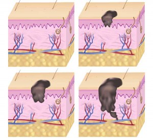 lechenie-melanomy-v-izraile